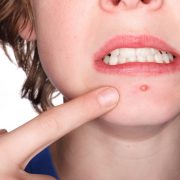 Top 5 Causes of Acne, and How to Best Protect Yourself from Them