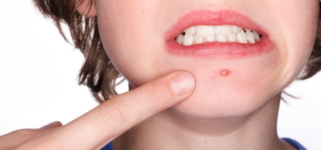 Top 5 Causes of Acne, and How to Best Protect Yourself from Them