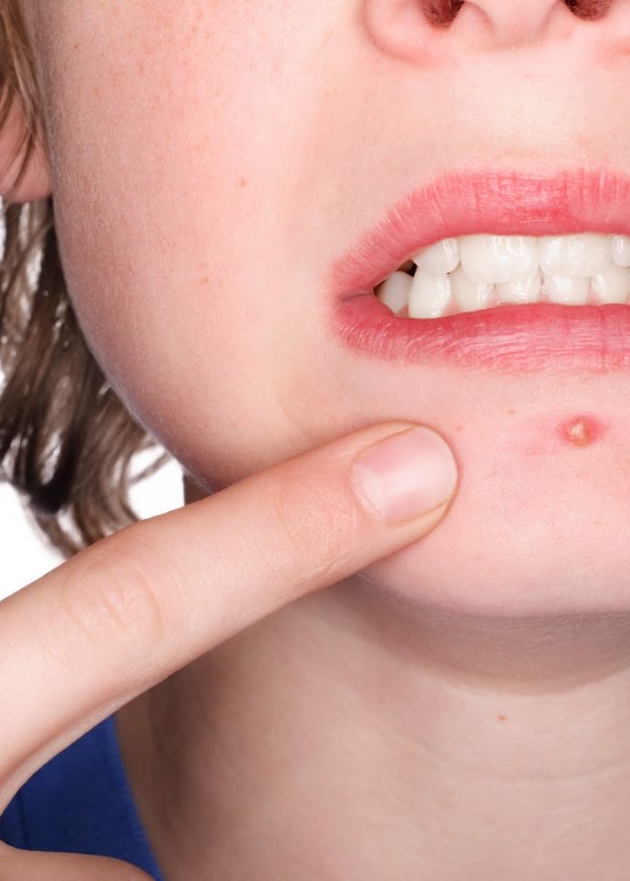 Top 5 Causes of Acne, and How to Best Protect Yourself from Them