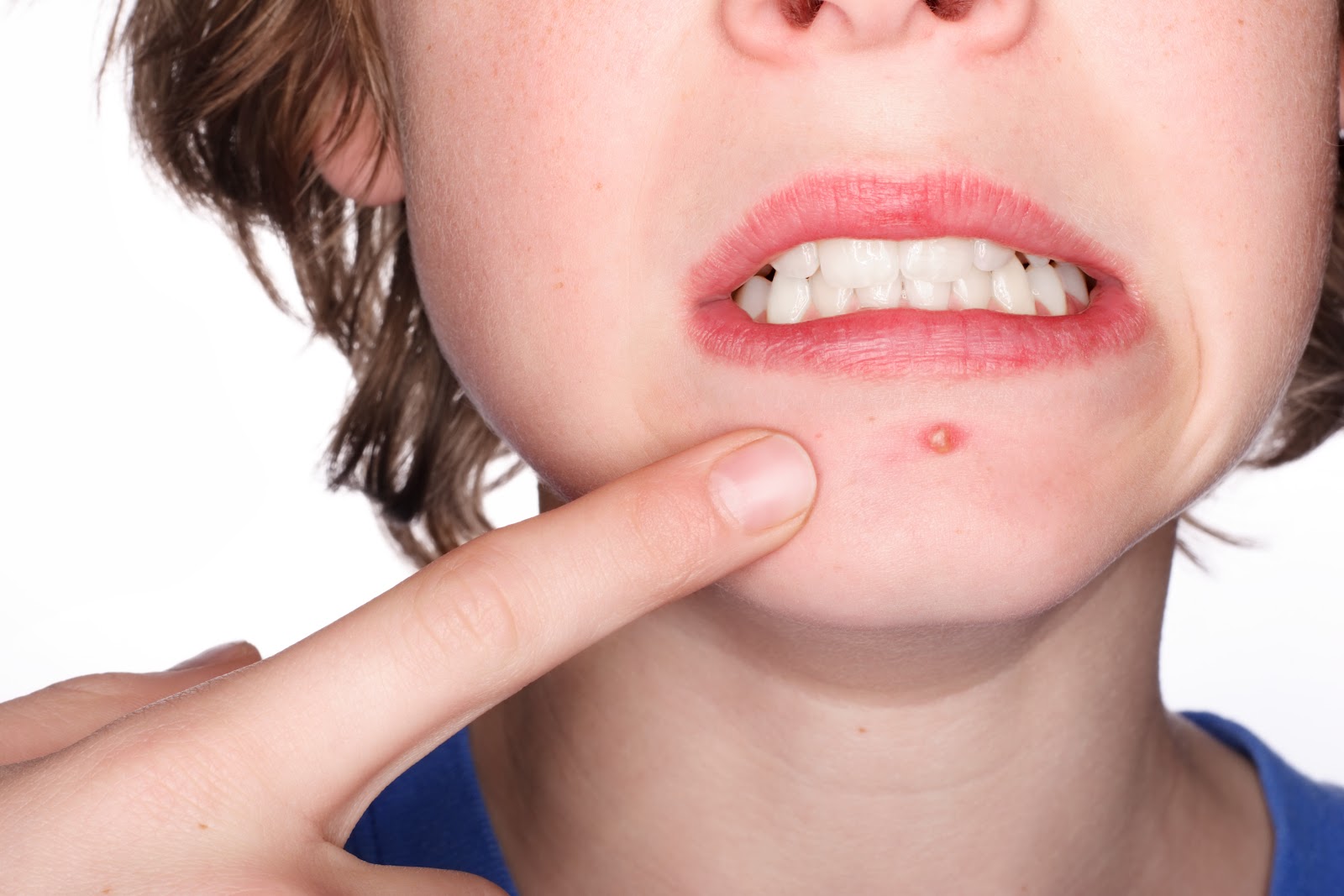 Top 5 Causes of Acne, and How to Best Protect Yourself from Them