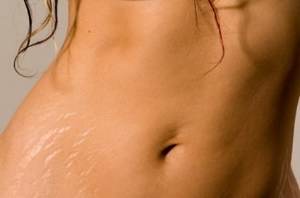 Three Ways to Effectively Get Rid of Stretch Marks