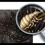 3 Tips to Get Rid of Lice