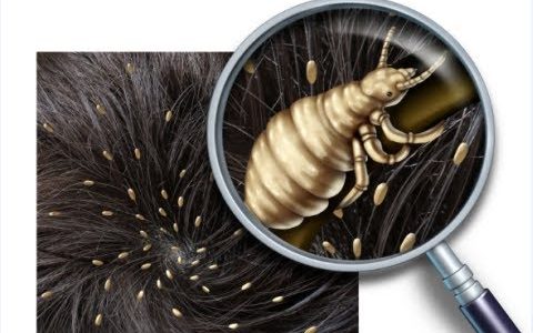 3 Tips to Get Rid of Lice