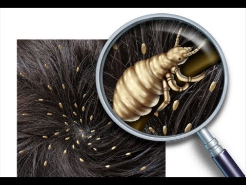 3 Tips to Get Rid of Lice