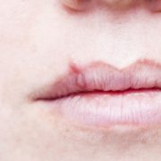 Here Are 6 Natural Ways To Show Your Cold Sores The Door