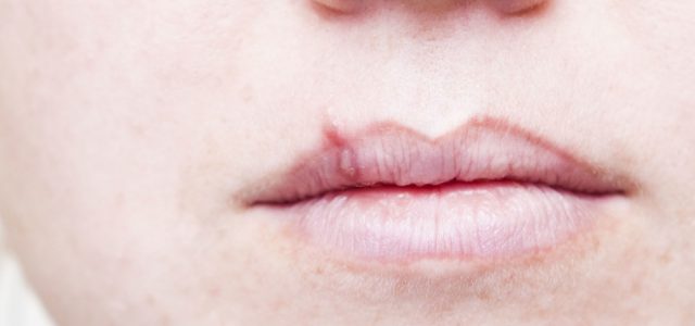 Here Are 6 Natural Ways To Show Your Cold Sores The Door