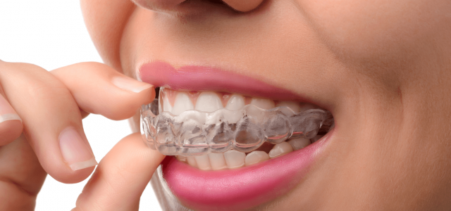 Can Invisalign Really Perfect Your Teeth?