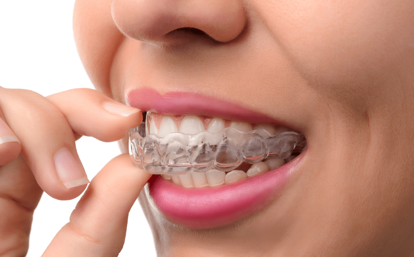 Can Invisalign Really Perfect Your Teeth?