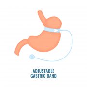 Gastric Bypass Surgery; How This Procedure Can Help with Weight Loss