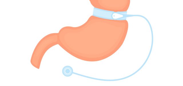 Gastric Bypass Surgery; How This Procedure Can Help with Weight Loss