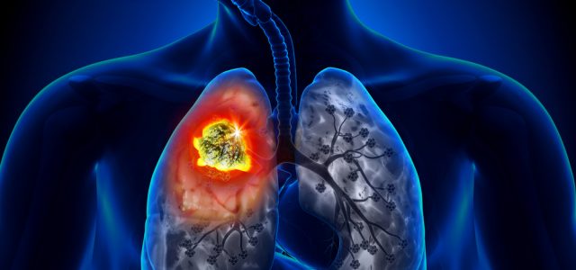 Lung Cancer: Symptoms And Treatment Options