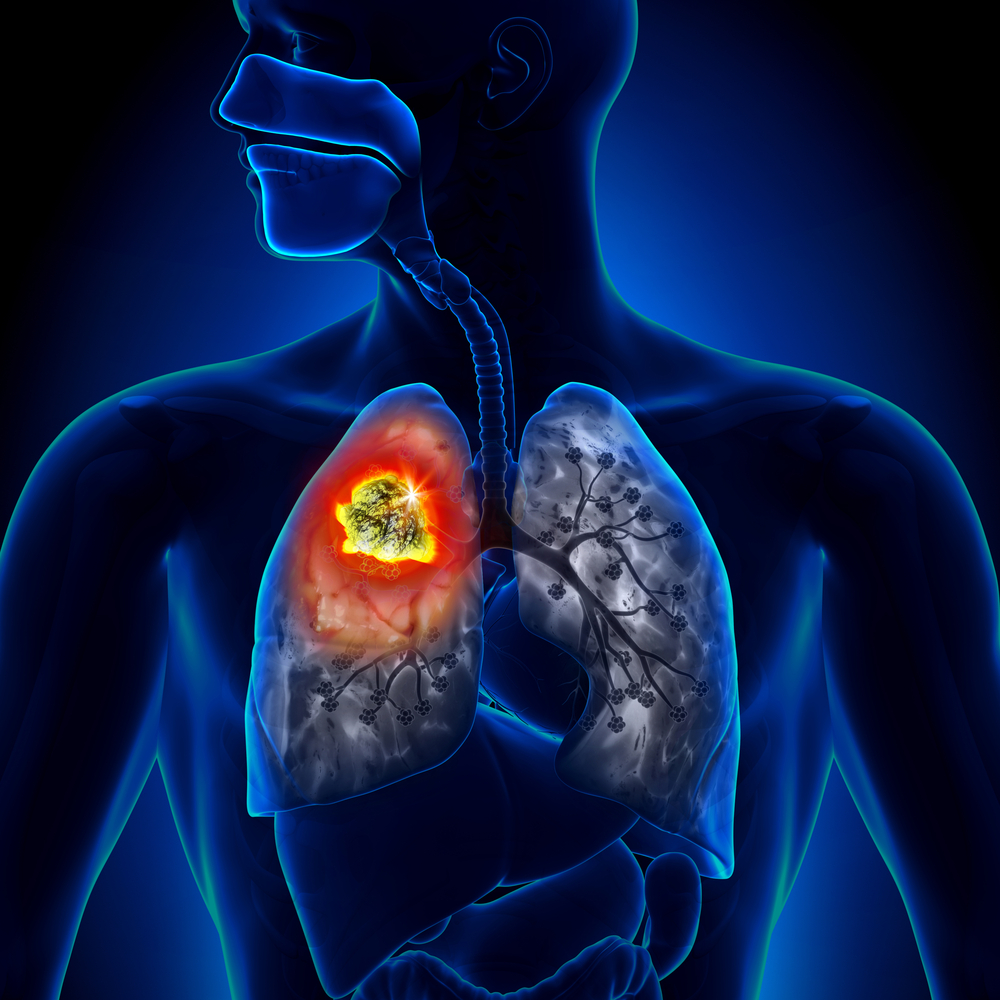 Lung Cancer: Symptoms And Treatment Options